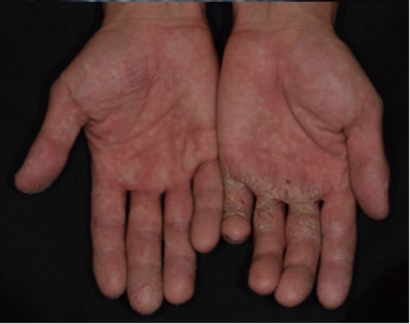 乾燥・亀裂型手湿疹