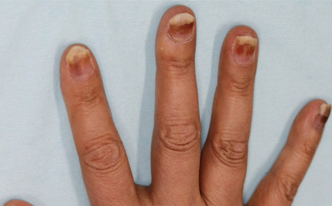 細胞障害性抗がん剤〔パクリタキセル〕による爪囲炎