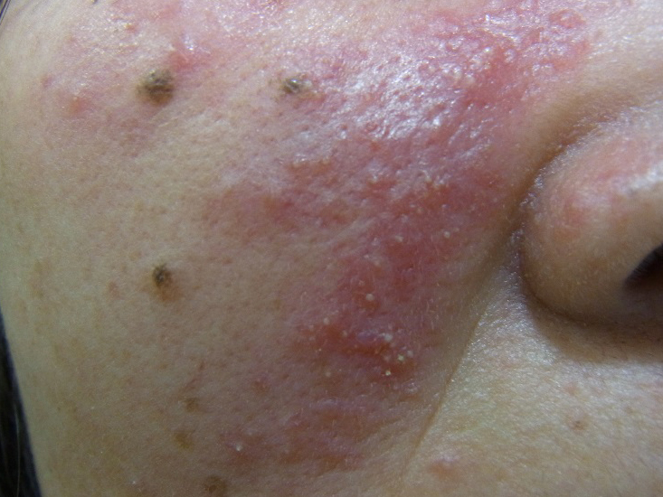 丘疹膿疱型の症状例