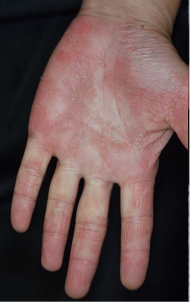 再発性水疱型（汗疱型）手湿疹
