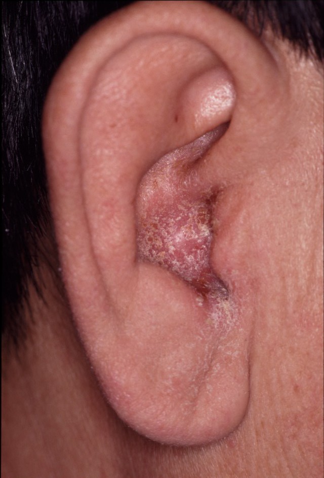 外耳道入り口の皮疹