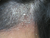 フケは湿疹の原因になるのでしょうか?